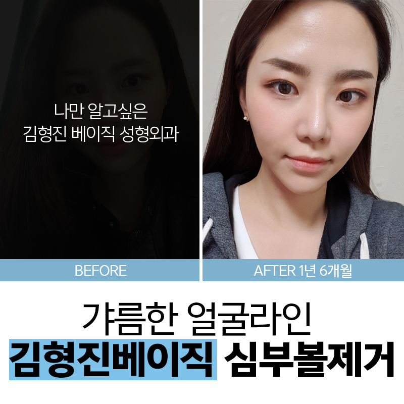 하악심부볼제거로 갸름한 얼굴라인을! 관련 이미지 5