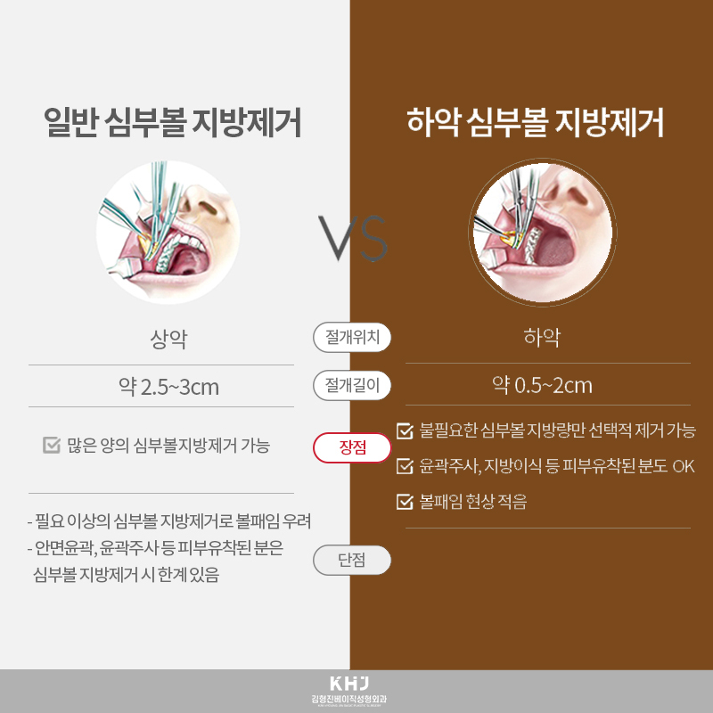 심부볼리프팅의 핵심, 이것 밖엔 방법이 없습니다! 관련 이미지 6