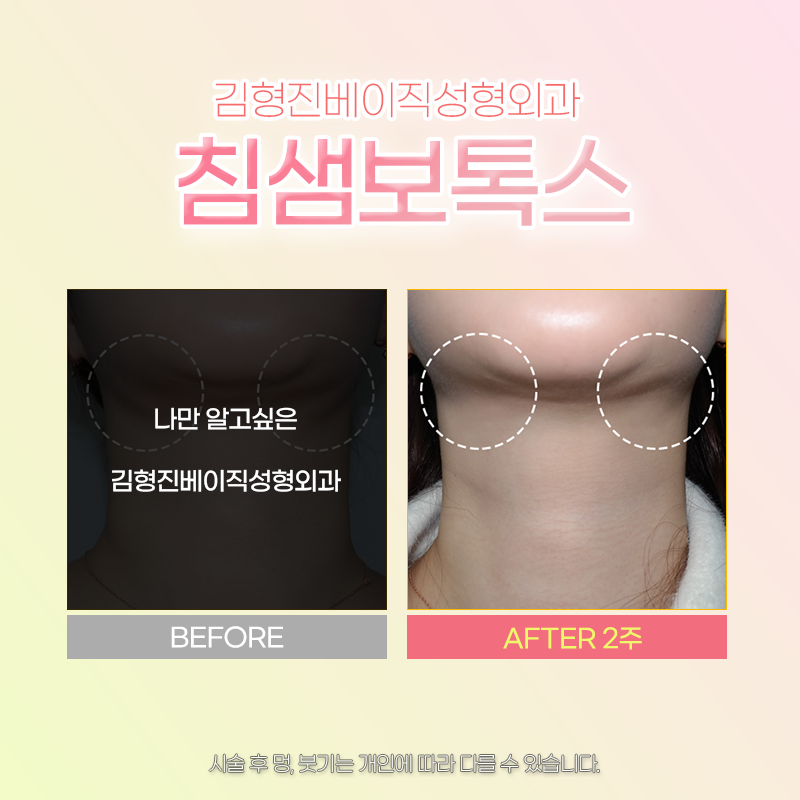침샘보톡스주기 확인하고 시술 받아야 하는 이유 관련 이미지 6