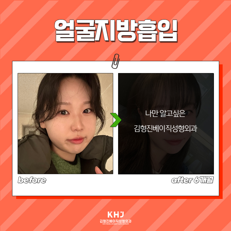 얼굴살빼는법 이렇게 빠르게 될 줄 몰랐어요... 관련 이미지 7