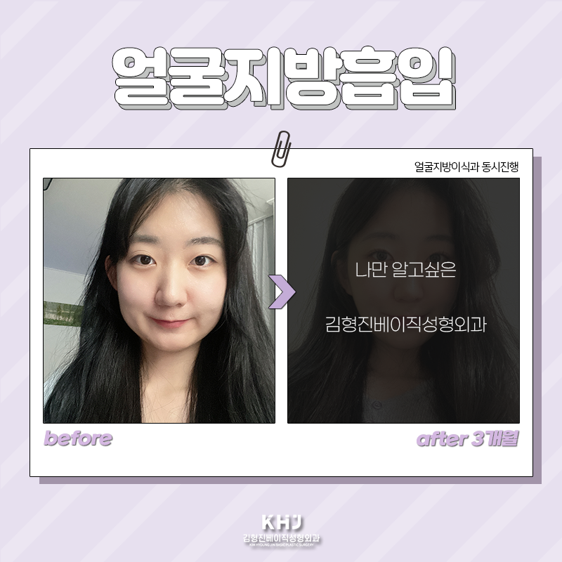 얼굴지방흡입전후 확인하고 가세요! 관련 이미지 5