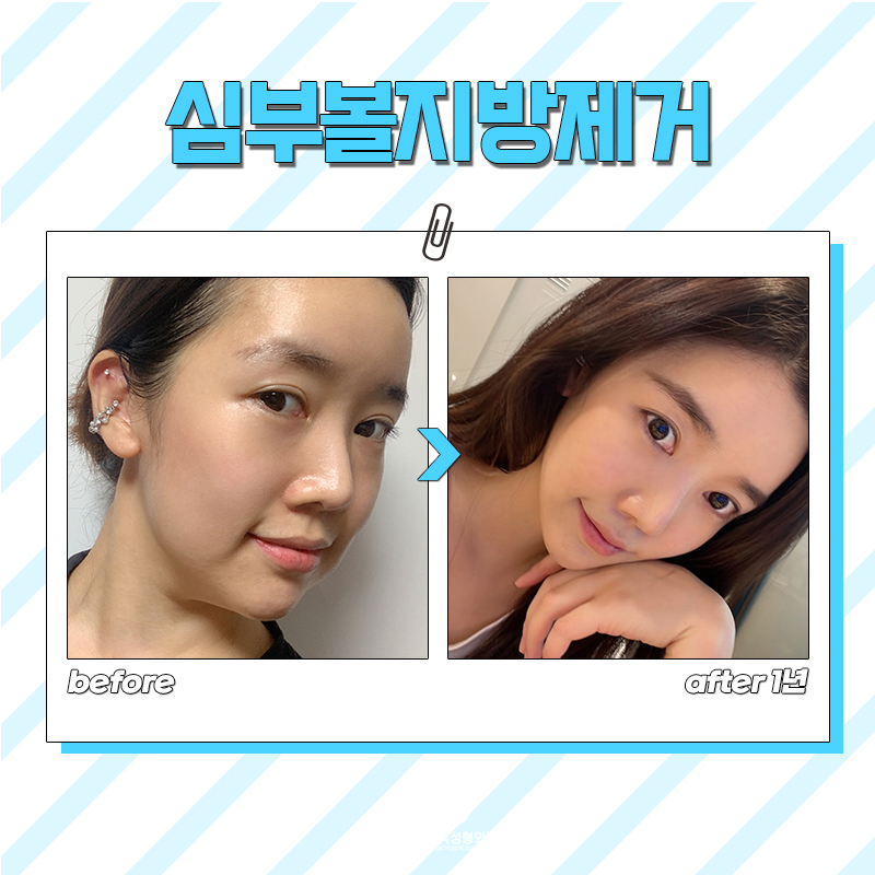 심부볼제거수술 덕분에 윤곽 필요 없어졌어요 관련 이미지 6