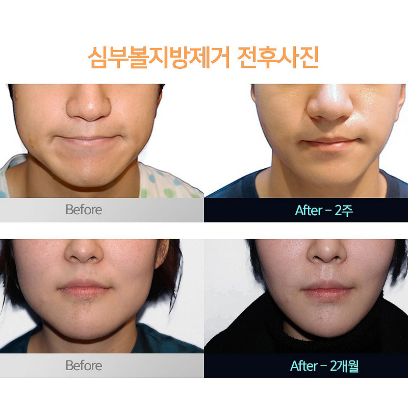 심부볼없애는법, 살짝만 변해도 얼굴형이 달라져요! 관련 이미지 5