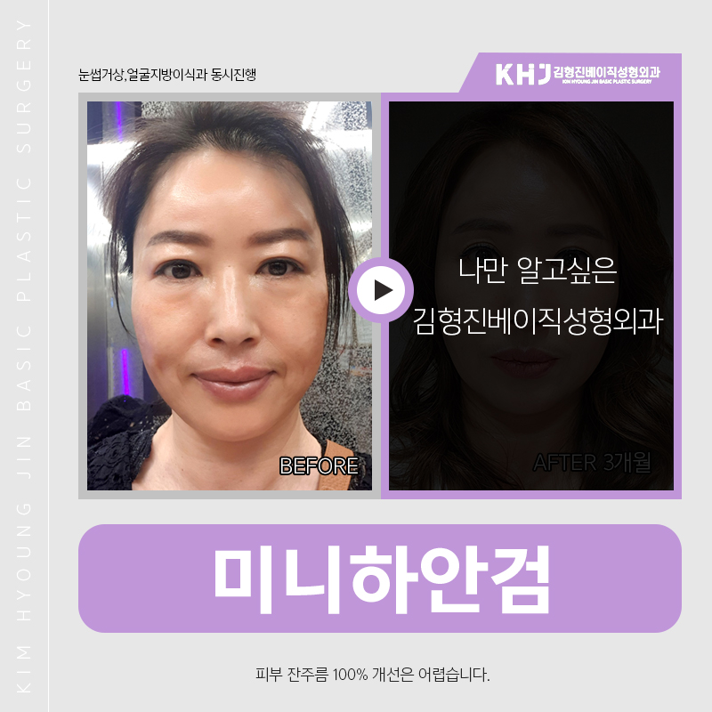 미니하안검회복기간 어느정도냐구요? 관련 이미지 3