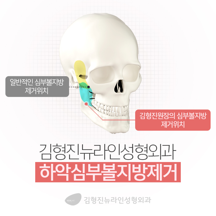얼굴지흡 하기전에 이것부터 관련 이미지 4