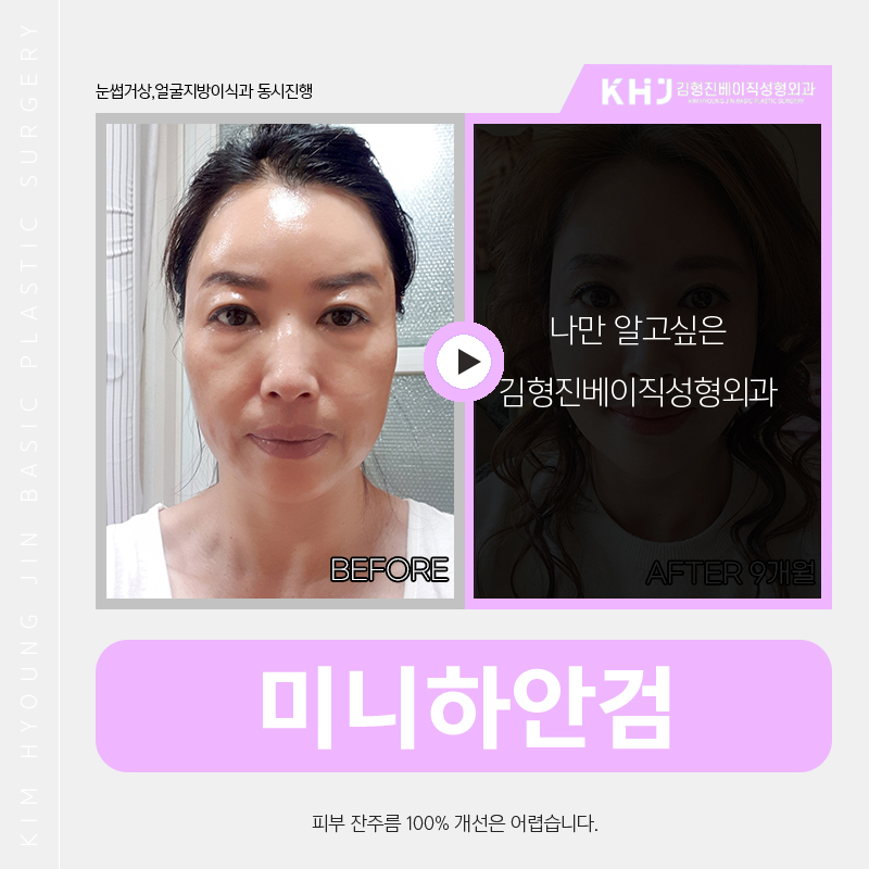 중년눈성형 고려 중이라면 김형진베이직에서! 관련 이미지 4