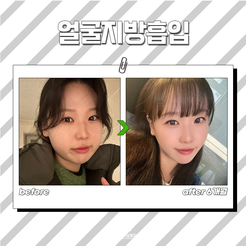 강남얼굴지방흡입은 무조건 김형진베이직이라고 하는 이유 관련 이미지 7