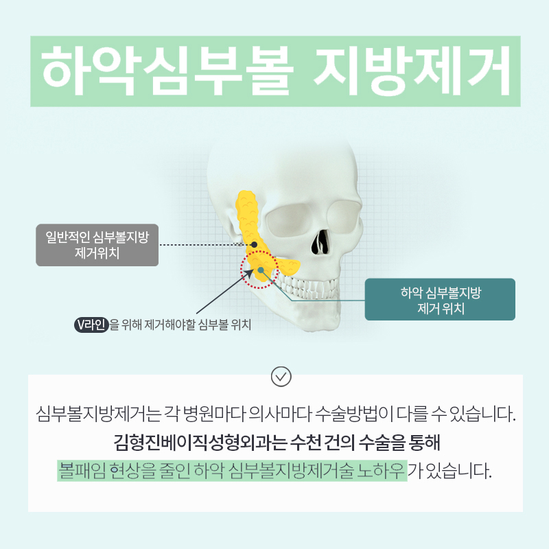 불독살없애는법 찾고 있다면? 김형진베이직의 심부볼지방제거로 매끄럽게 변신! 관련 이미지 4