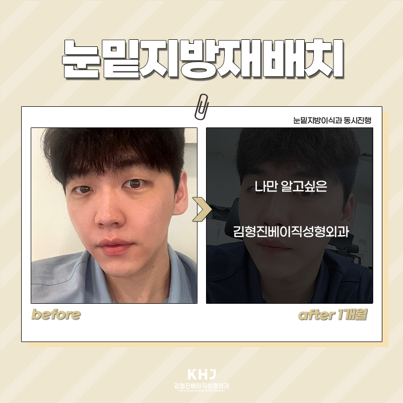 눈밑지방재배치회복기간 빠를 수밖에 없는 이유! 관련 이미지 5