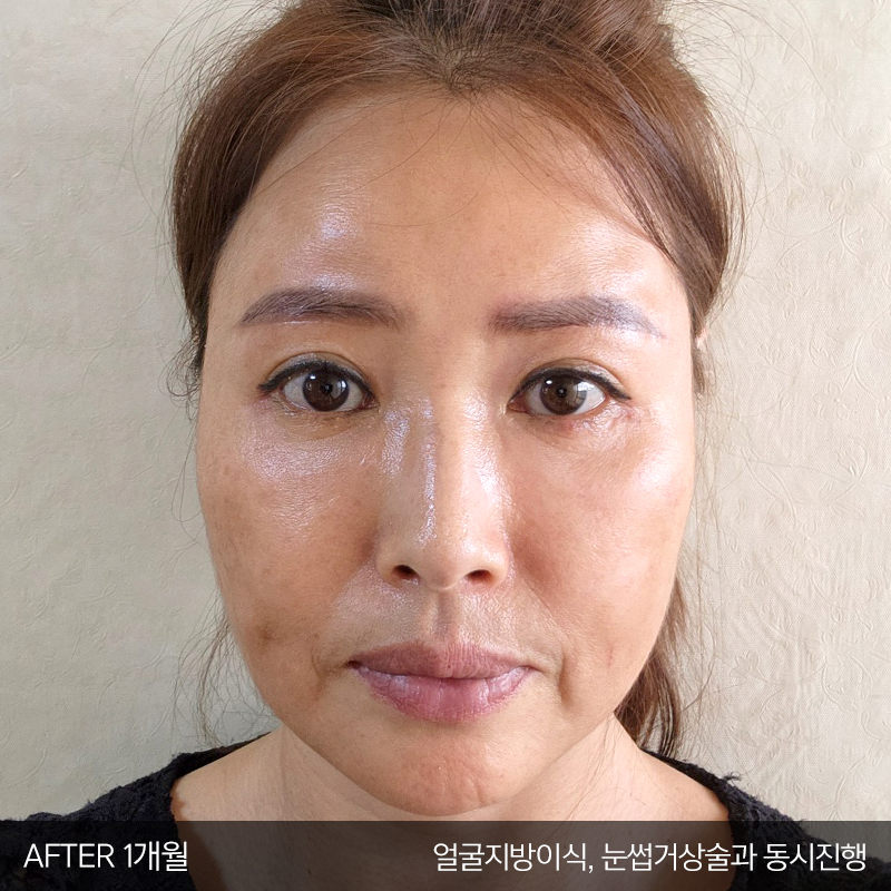 미니하안검수술은 김형진베이직이죠 관련 이미지 5