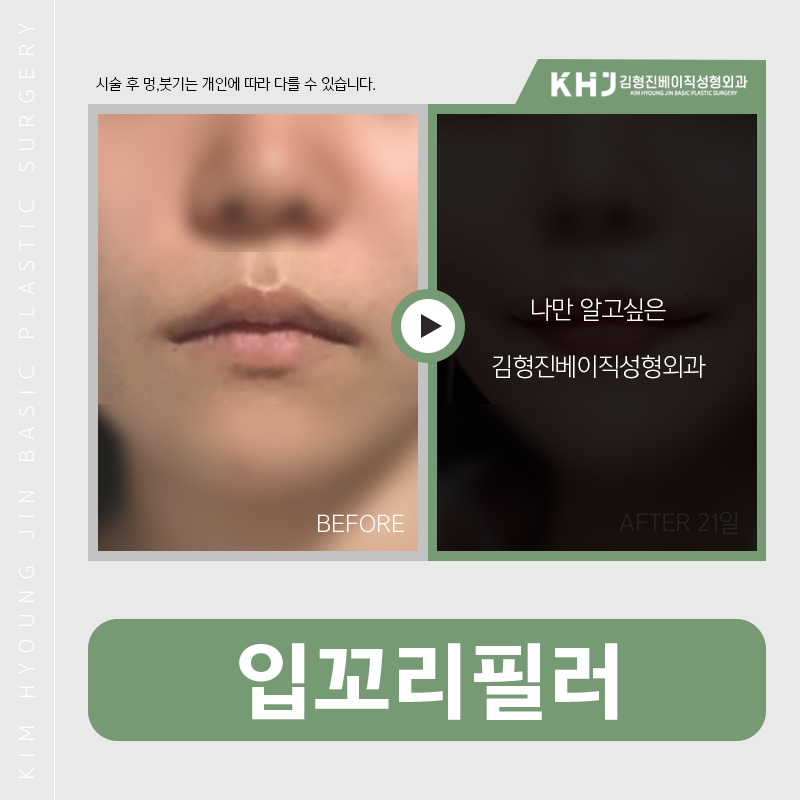 입꼬리필러후기 보고싶으신분 모여라! 관련 이미지 2