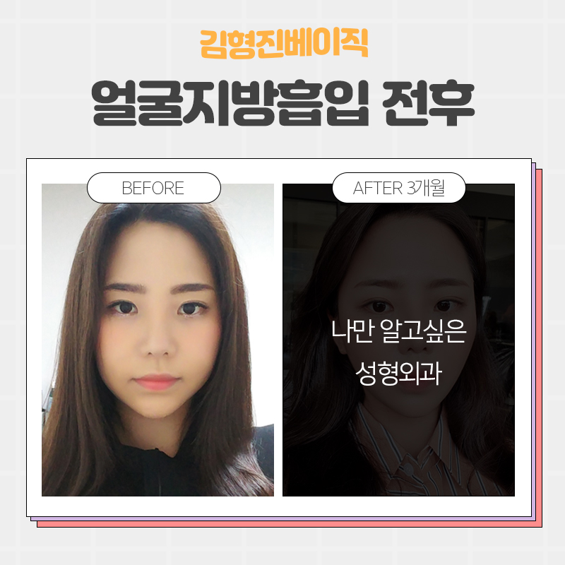 얼굴지흡후기 좋은 이유 궁금하시죠? 관련 이미지 4