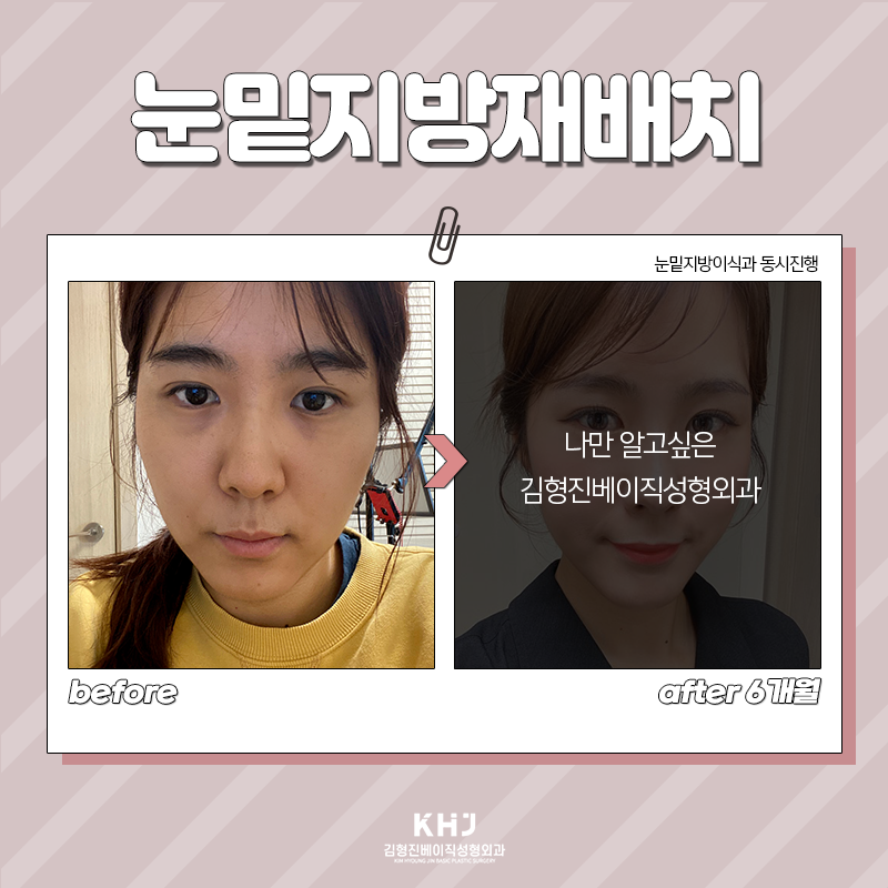 눈밑재수술 걱정하지 않아도 되는 이유 관련 이미지 6