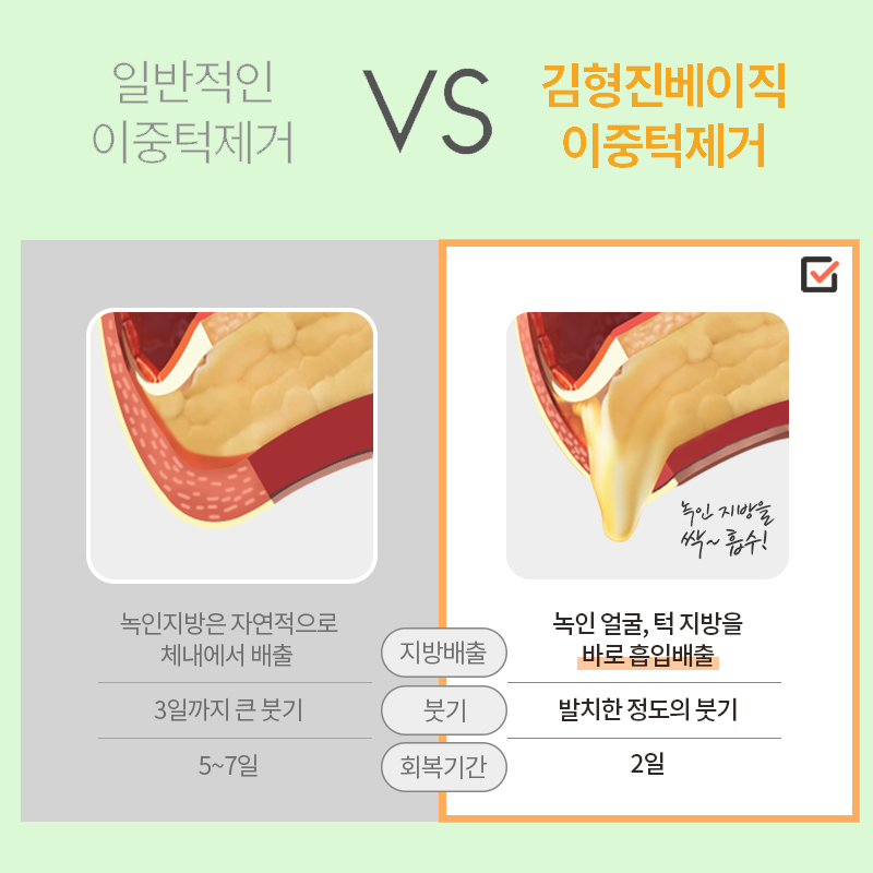 만약 이중턱지흡수술 안 받았으면 어쨌을까요 관련 이미지 5