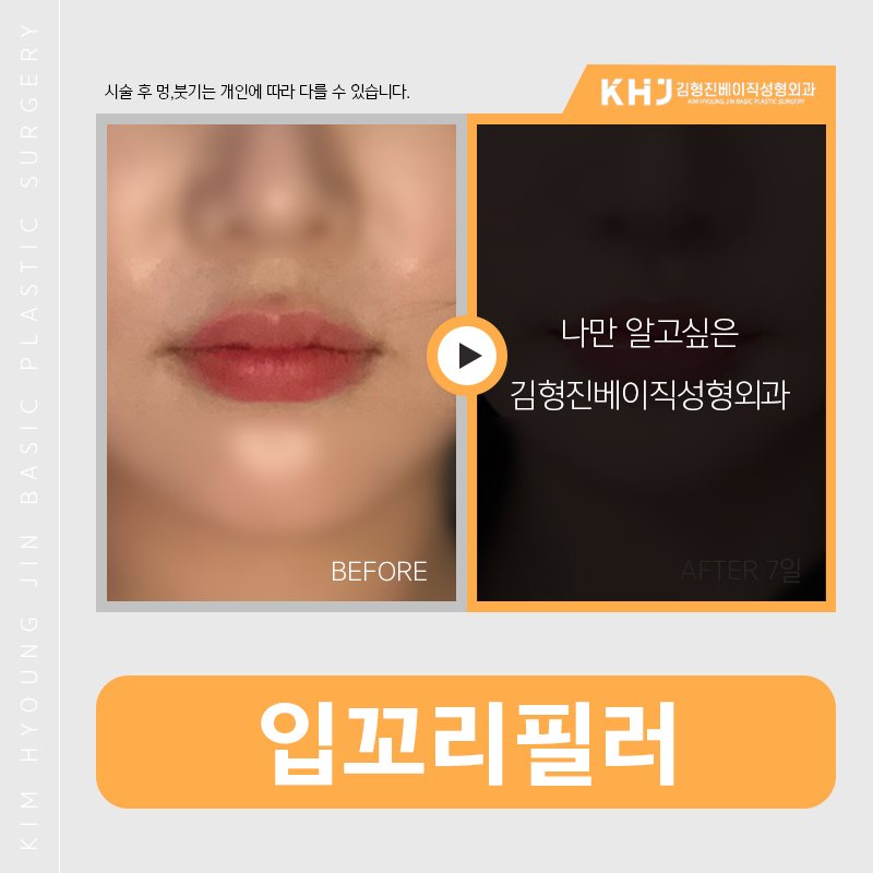 입꼬리필러통증 때문에 고민 노노 관련 이미지 2