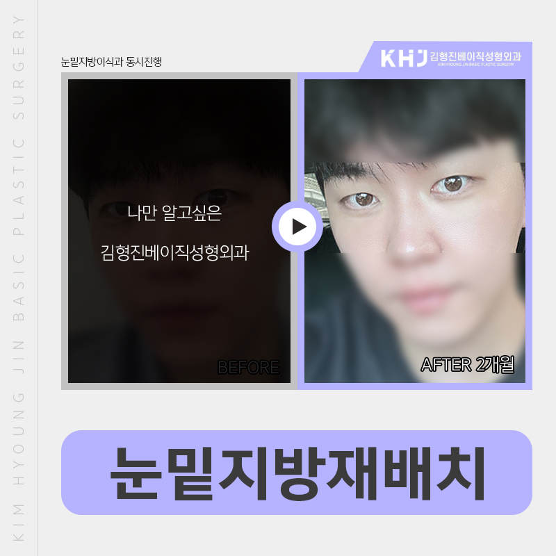 눈밑지방없애는법 김형진베이직에서는 관련 이미지 4