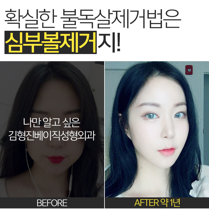 불독살 제거는 이 방법 뿐★ 관련 이미지 4