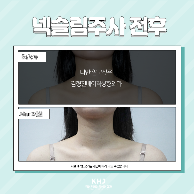 넥슬림주사전후 확인하고 가세요~! 관련 이미지 4