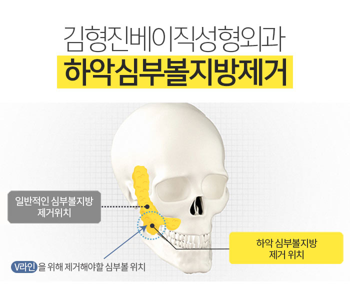 불독살 제거는 이 방법 뿐★ 관련 이미지 6