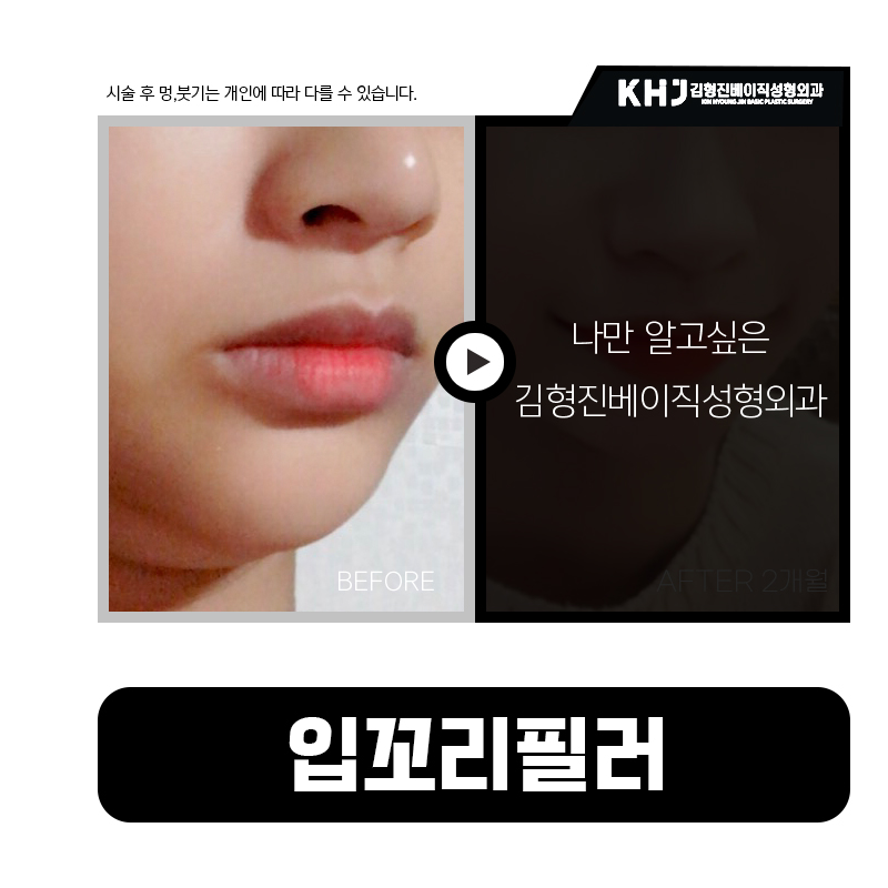 입꼬리비대칭? 입꼬리필러로 생기 있는 미소 완성! 관련 이미지 5