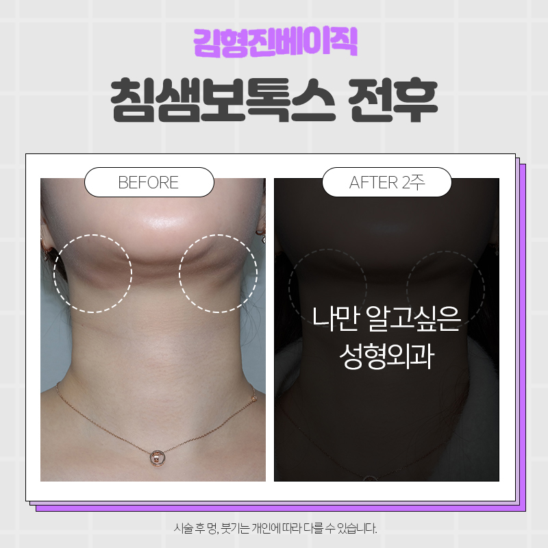 압구정침샘보톡스로 둔해 보이는 턱 선을 갸름하게 관련 이미지 5