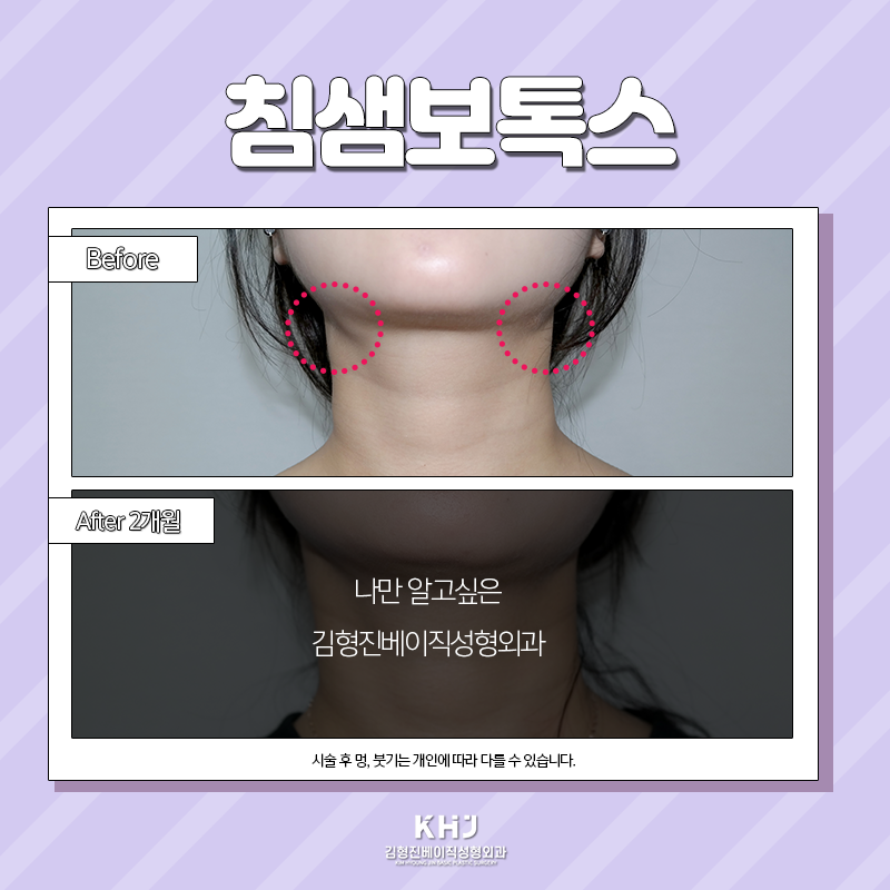 침샘보톡스효과 이렇게나 좋다구요! 관련 이미지 3