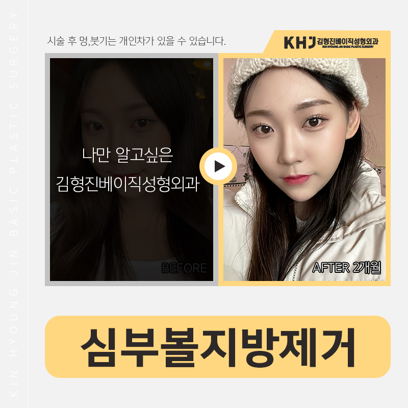 심부볼제거 부작용 걱정 왜 해요? 관련 이미지 3