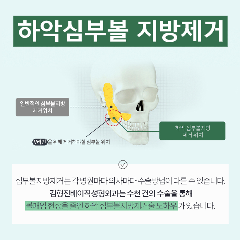 심부볼볼패임 때문에 망설이고 계신 분 들어오세요! 관련 이미지 5