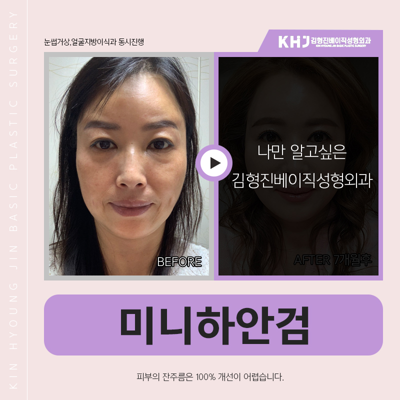 미니하안검흉터 걱정하지마세요! 관련 이미지 5