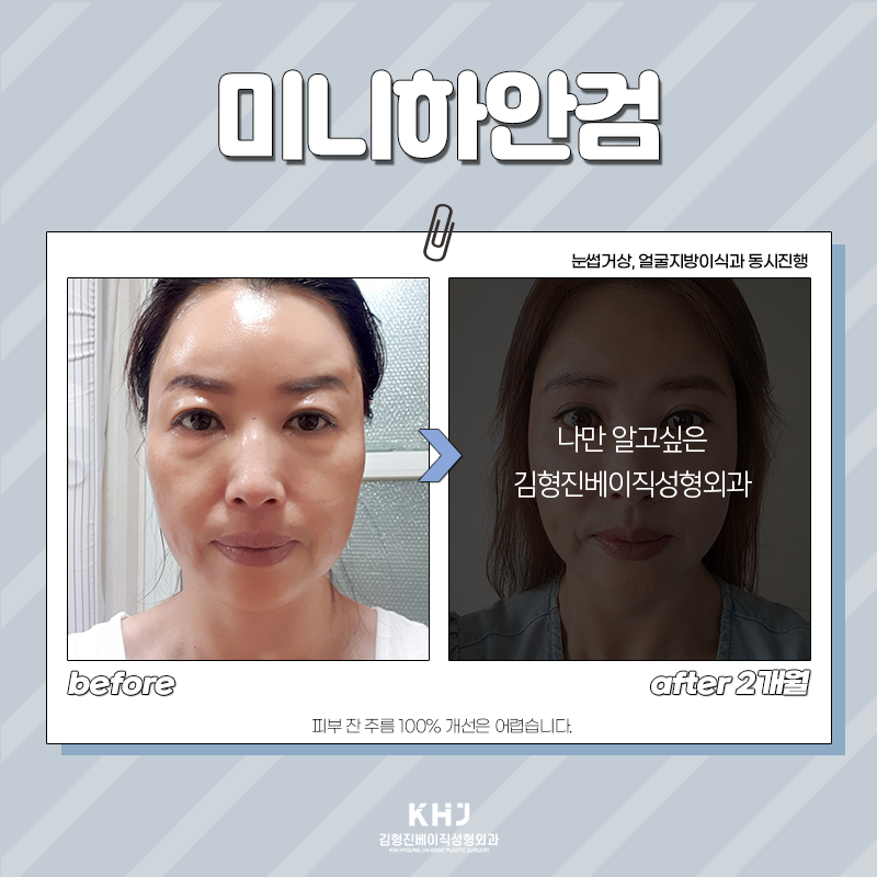 미니하안검절개 부담 갖지 마세요! 관련 이미지 3