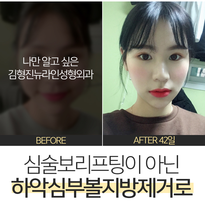 심술보리프팅 김형진뉴라인에서는? 관련 이미지 6