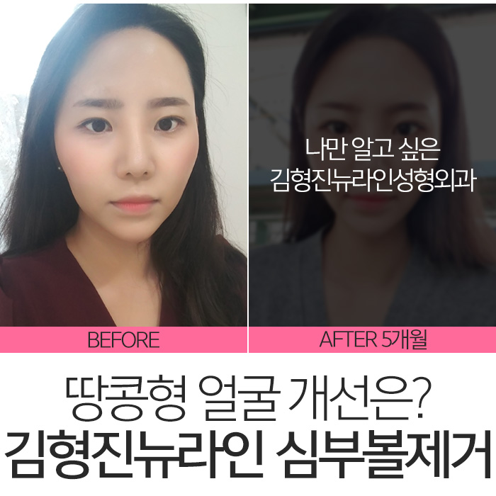 땅콩형얼굴 고민만 하고 있나요? 관련 이미지 2