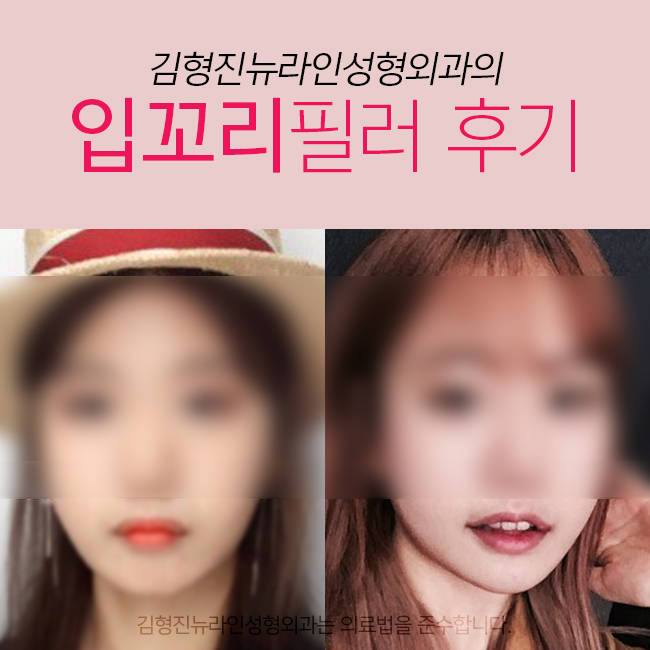 입꼬리필러후기 이정도는 되야지 관련 이미지 3