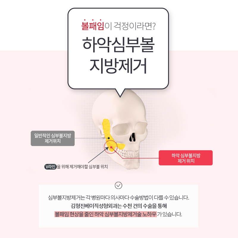 심부볼지방제거수술로 처진 불독살 개선 끝 관련 이미지 5