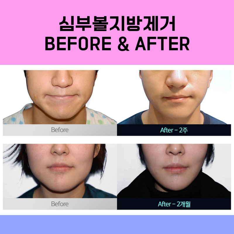 I Found the Way to Get Rid of the Deep Cheek Fat That Was Stressing Me Out! image 6