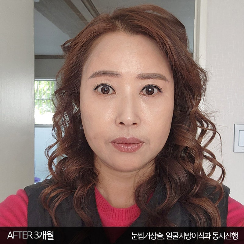 미니하안검수술방법 궁금하시죠? 관련 이미지 4