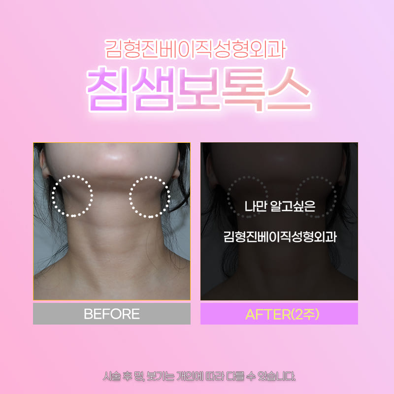 침샘비대증치료는 경험이 많은 곳에서 관련 이미지 6