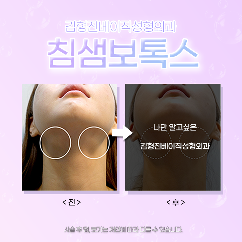 침샘보톡스시술주기 확인하셔야죠! 관련 이미지 5