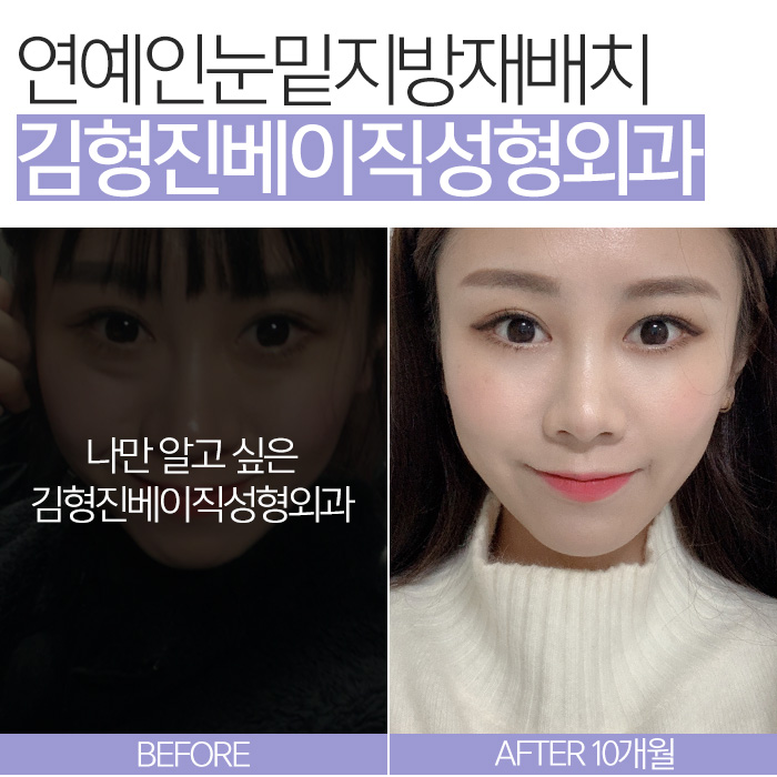 연예인눈밑지방재배치 이런 거구나 관련 이미지 3