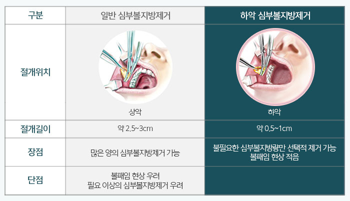 심부볼제거후기 진짜를 보여주지 관련 이미지 4