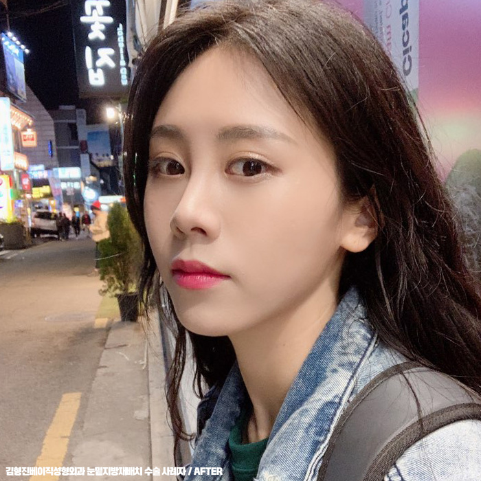 눈밑지방재배치후기 봐줄거죠? 관련 이미지 2