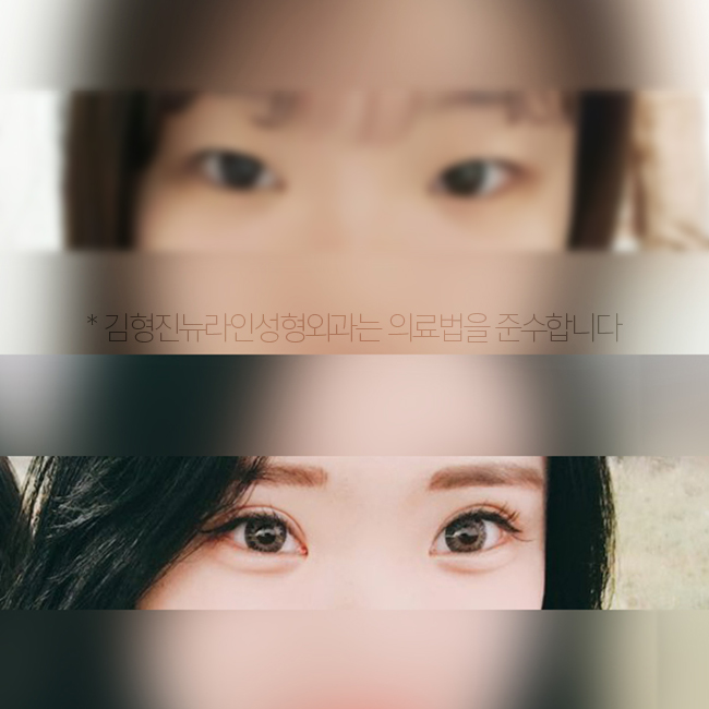 학생 쌍수 후기 리얼로 보니 하고 싶잖아~ 관련 이미지 6