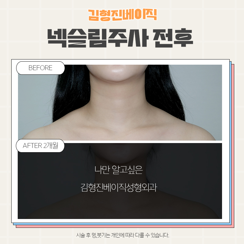 목보톡스후기 김형진베이직만 한 곳 없죠 관련 이미지 2