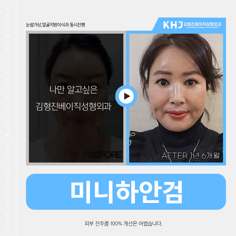 눈밑처짐수술로 나이 들어 보이는 노안 이미지 탈출했어요! 관련 이미지 6