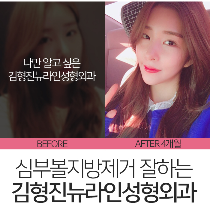 압구정심부볼제거 남다른 후기 관련 이미지 7