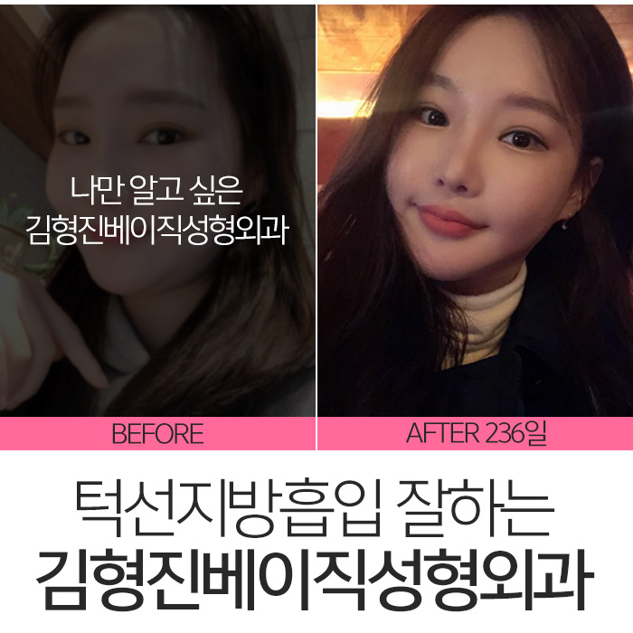 턱선지방흡입 김형진베이직성형외과 짜란다 관련 이미지 3