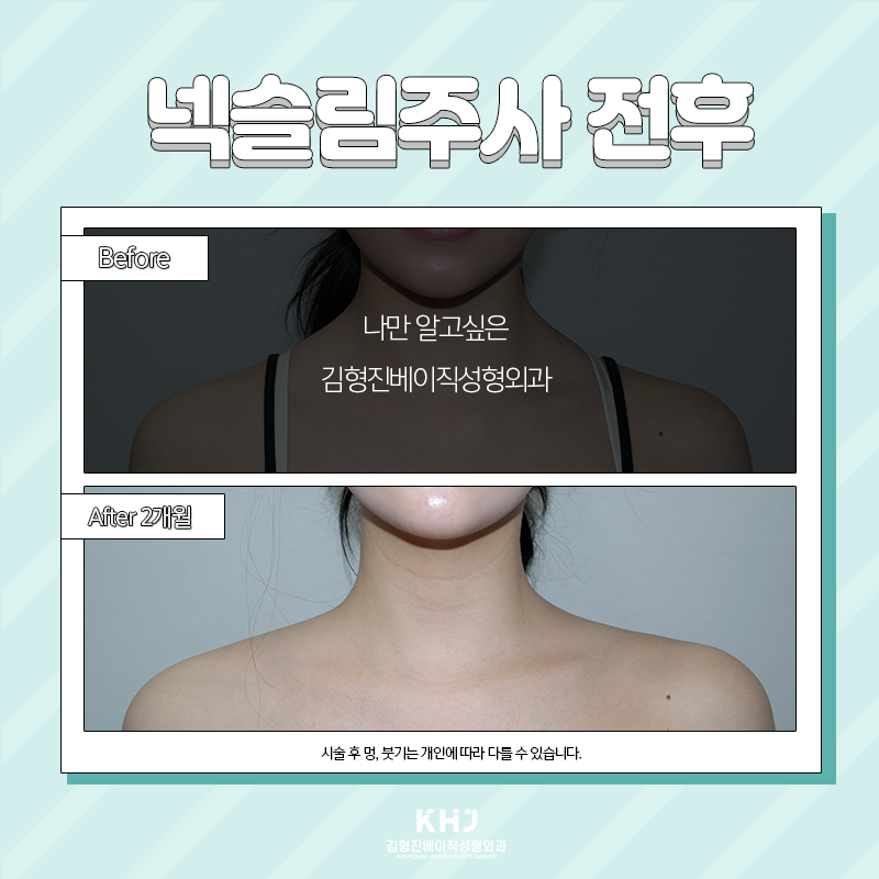 두꺼운목 고민은 이제 그만~! 관련 이미지 6