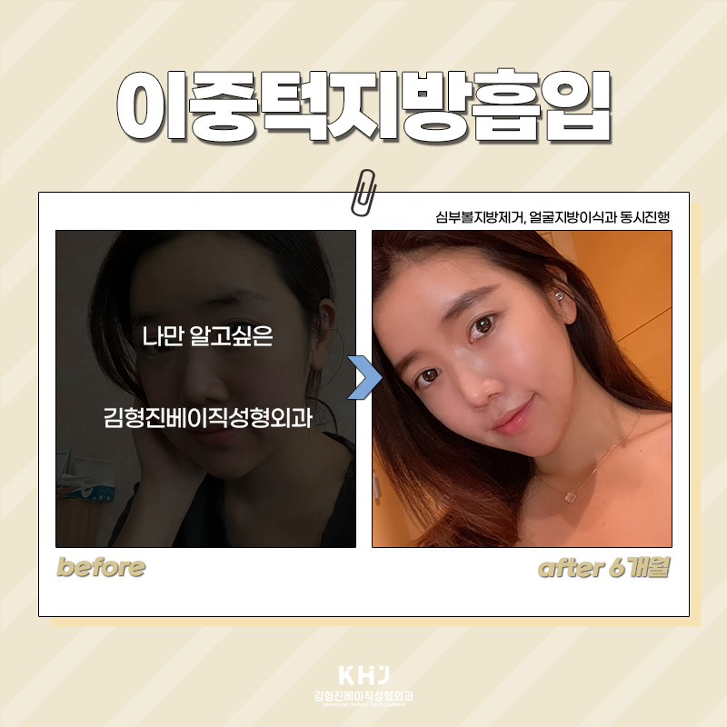 이중턱지방흡입전후 보고 가세요! 관련 이미지 5