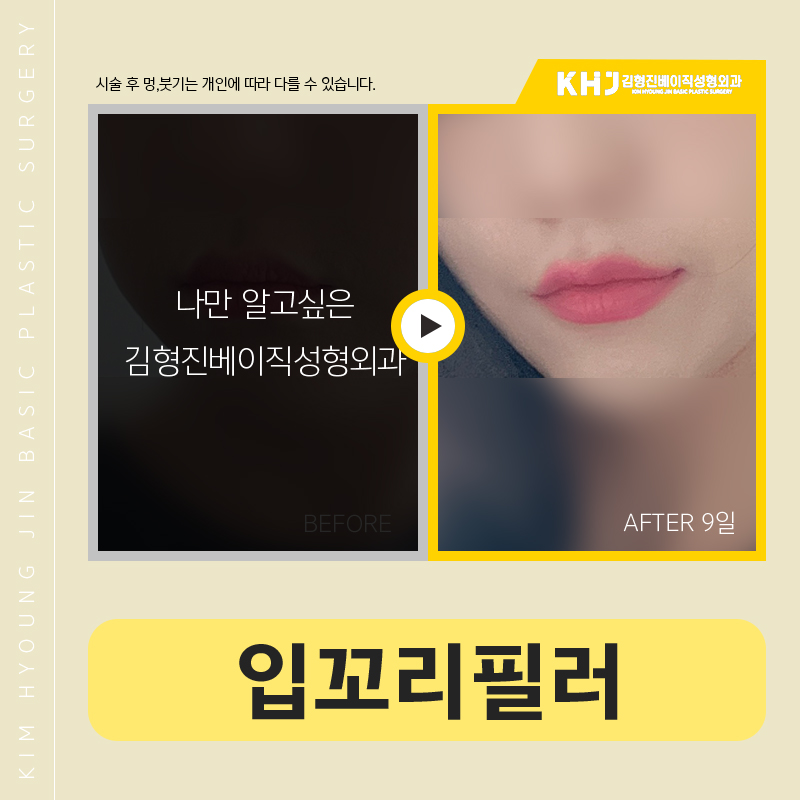 입꼬리필러전후 이보다 다를 수가 있나요? 관련 이미지 6