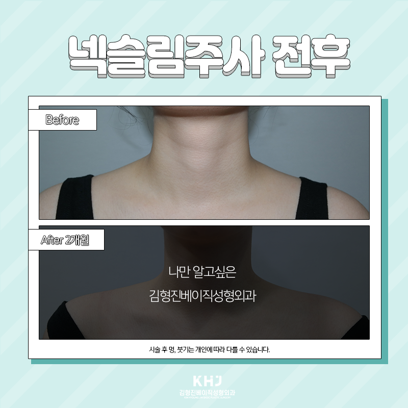 두꺼운목 고민은 이제 그만~! 관련 이미지 3